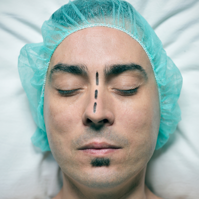 Male Rhinoplasty