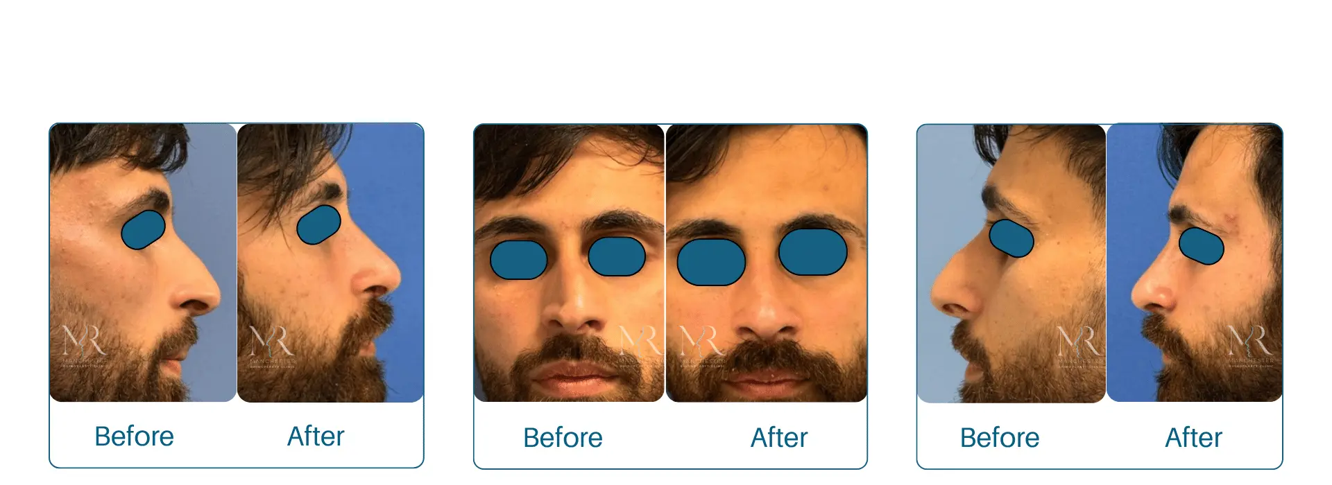 Male Rhinoplasty Pictures