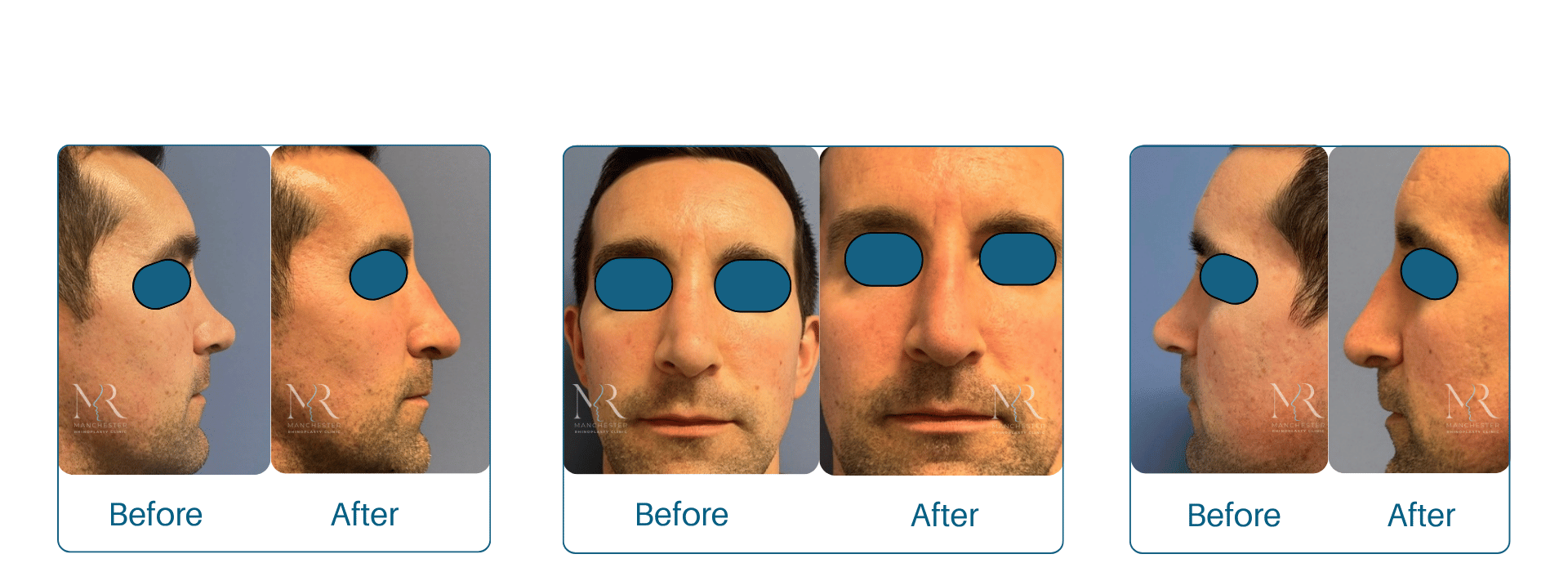 Male-Rhinoplasty-Pictures
