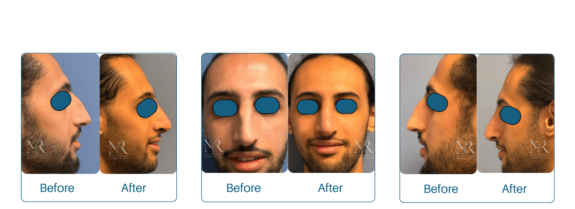Male-Rhinoplasty-Pictures
