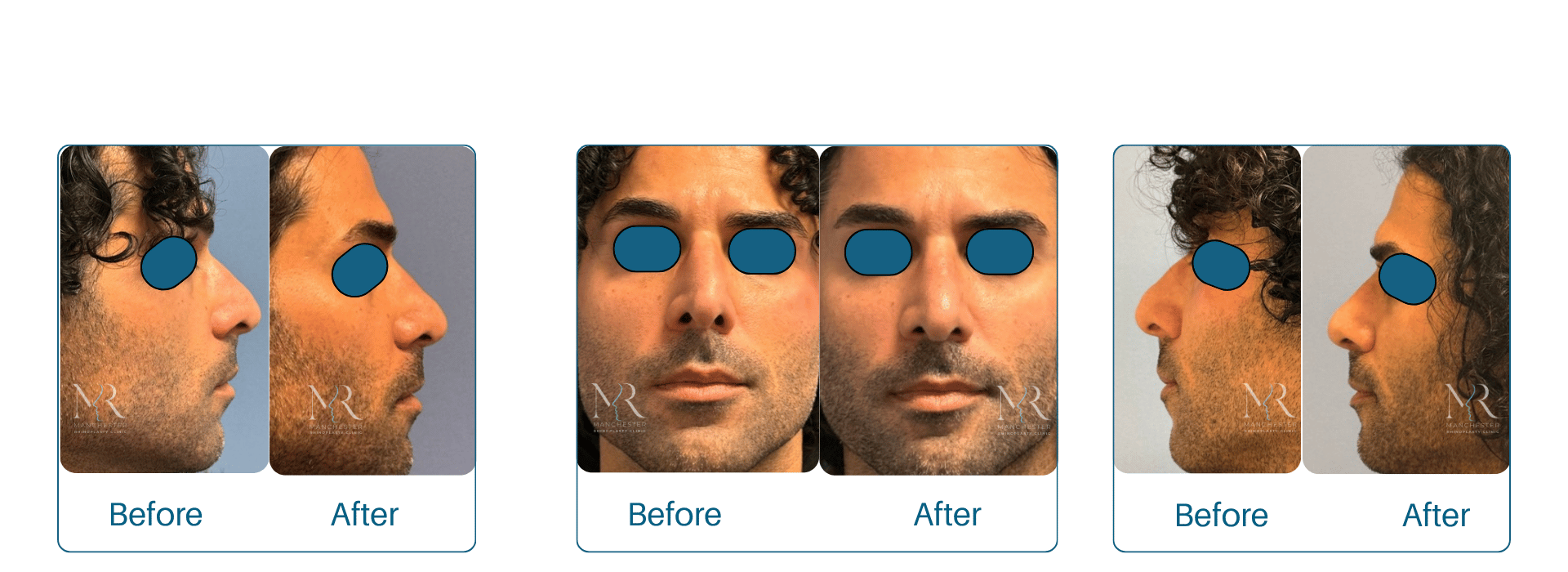 Male-Rhinoplasty-Pictures