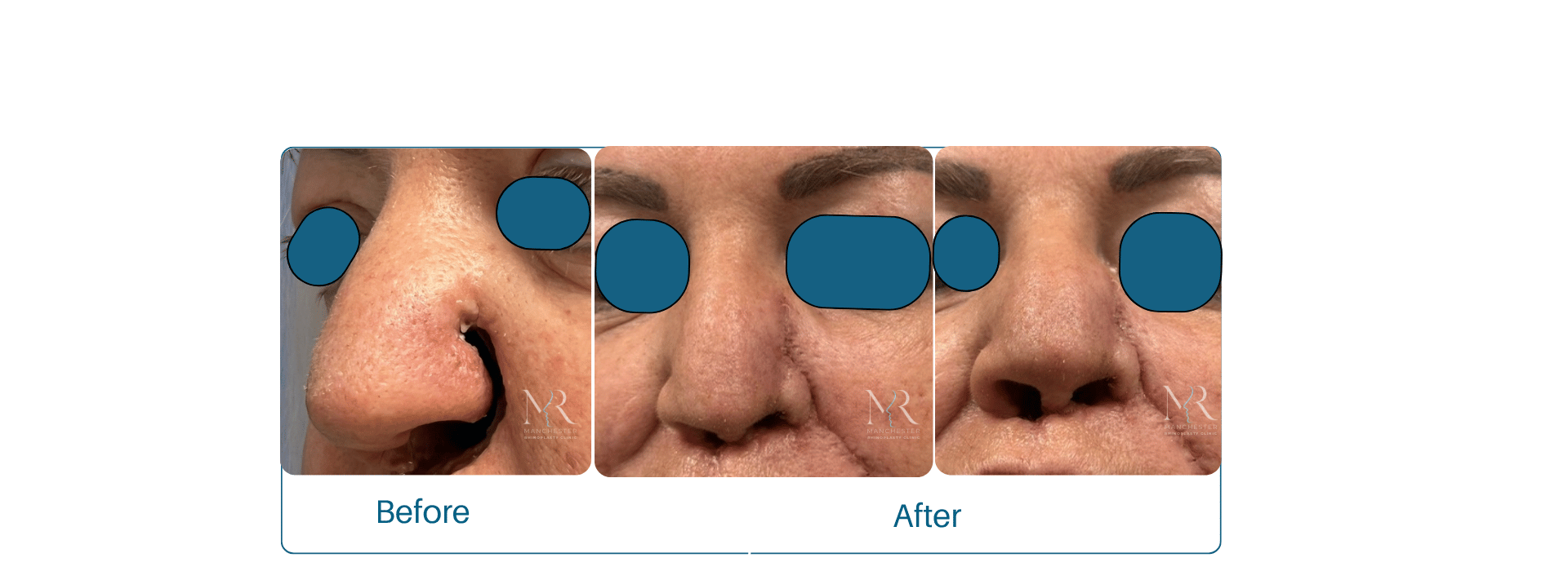 Nasal reconstruction