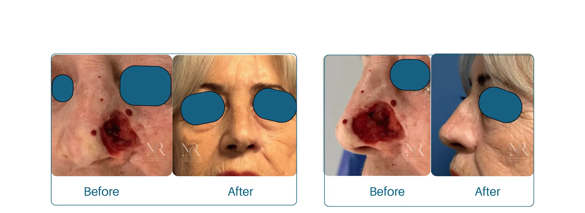 Nasal reconstruction