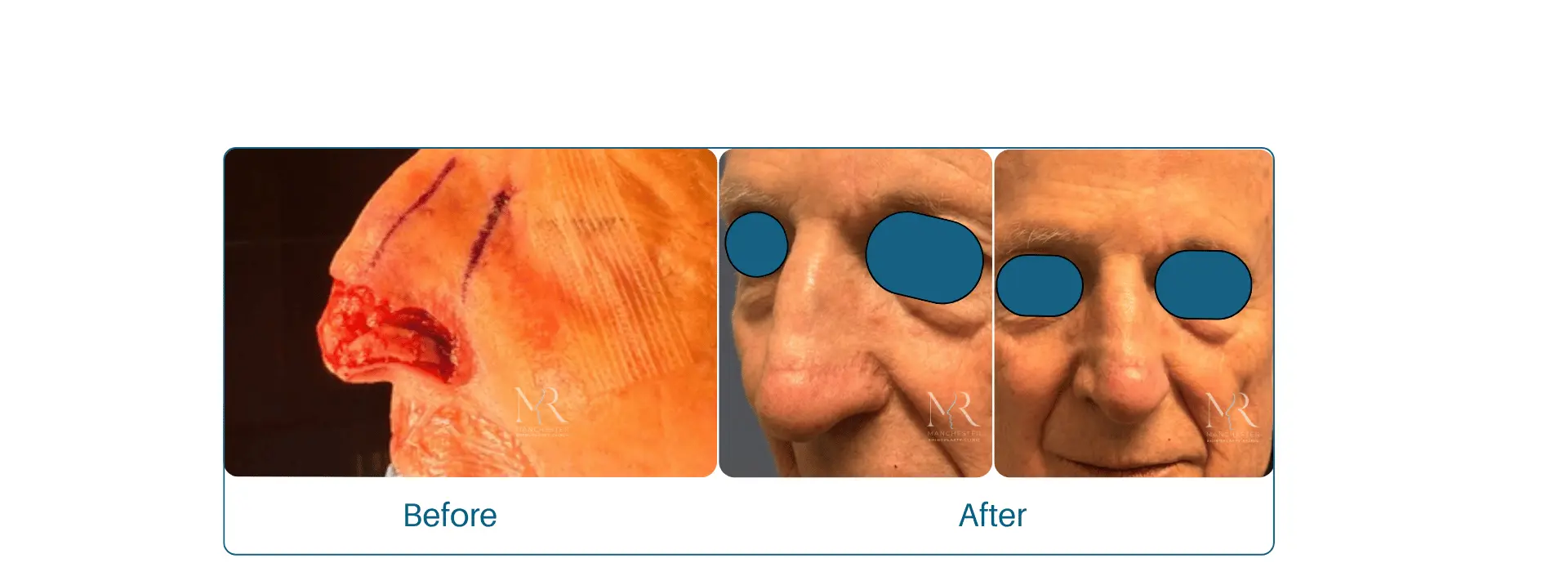 Nasal reconstruction