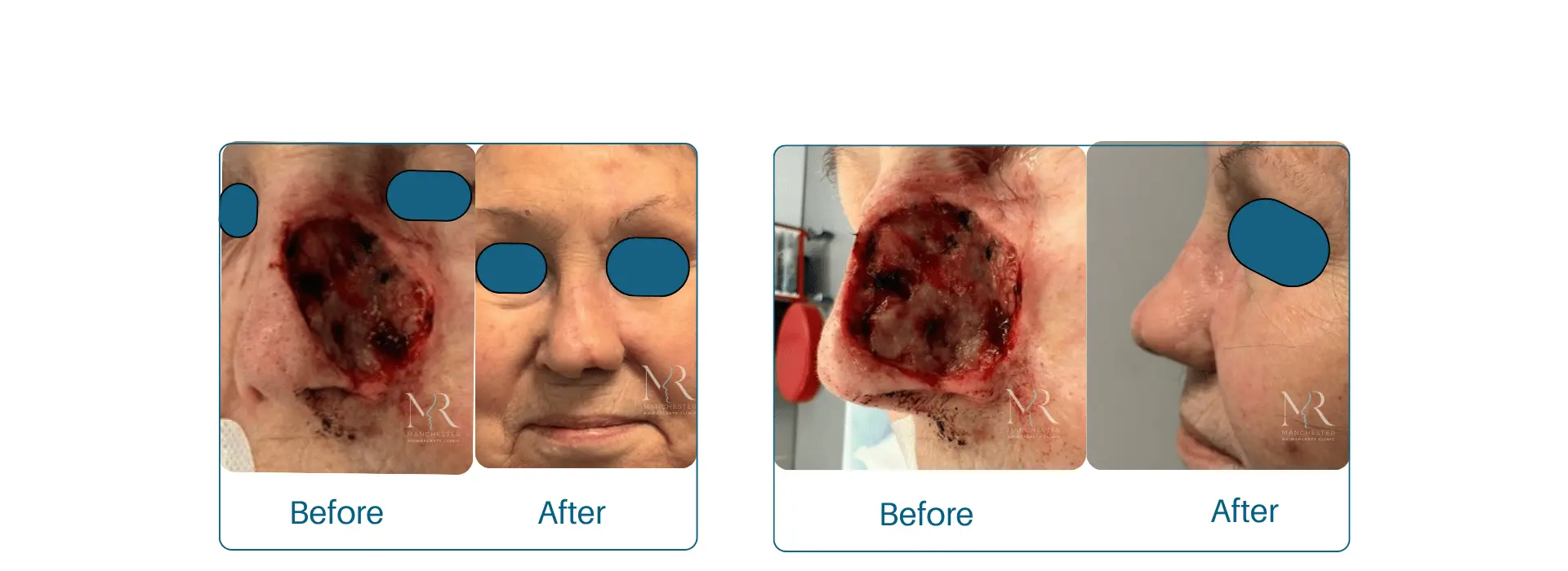 Nasal reconstruction