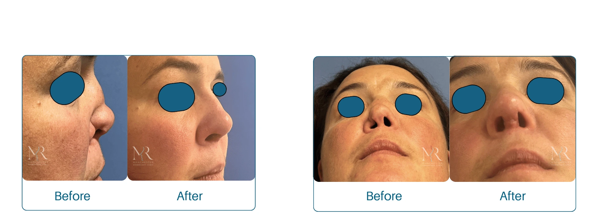 Reconstructive Rhinoplasty Pictures
