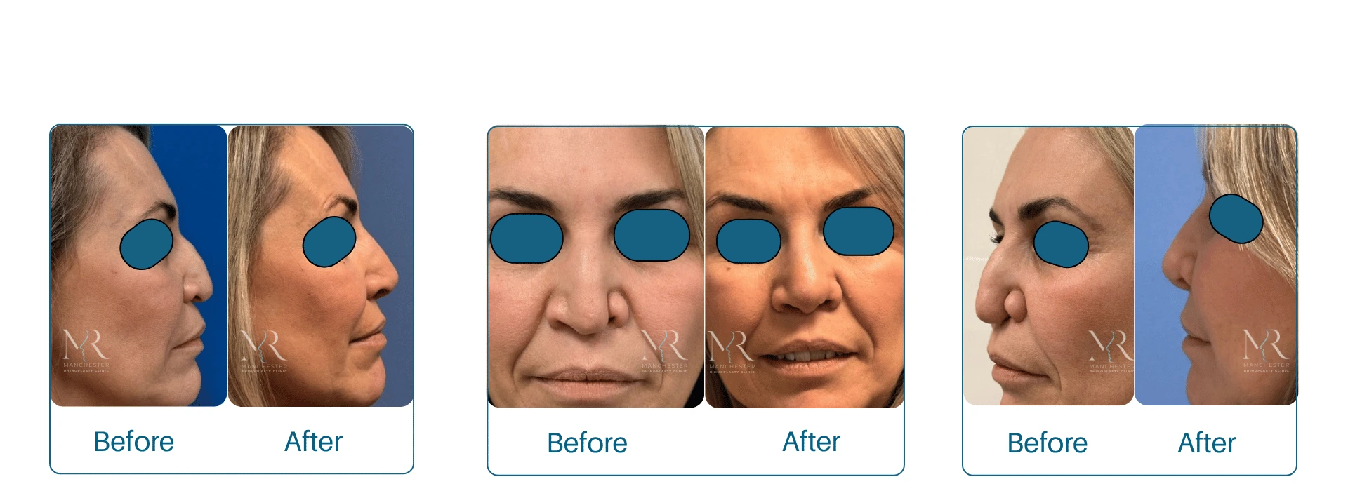 Reconstructive Rhinoplasty Pictures