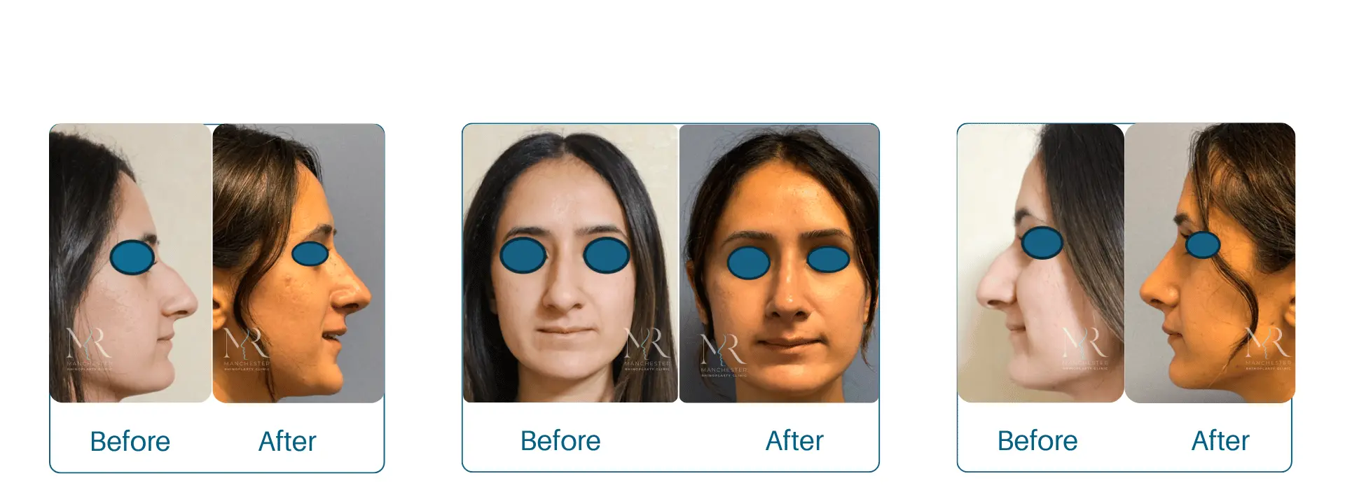 Before & After Rhinoplasty Pictures. Manchester Rhinoplasty clinic Results