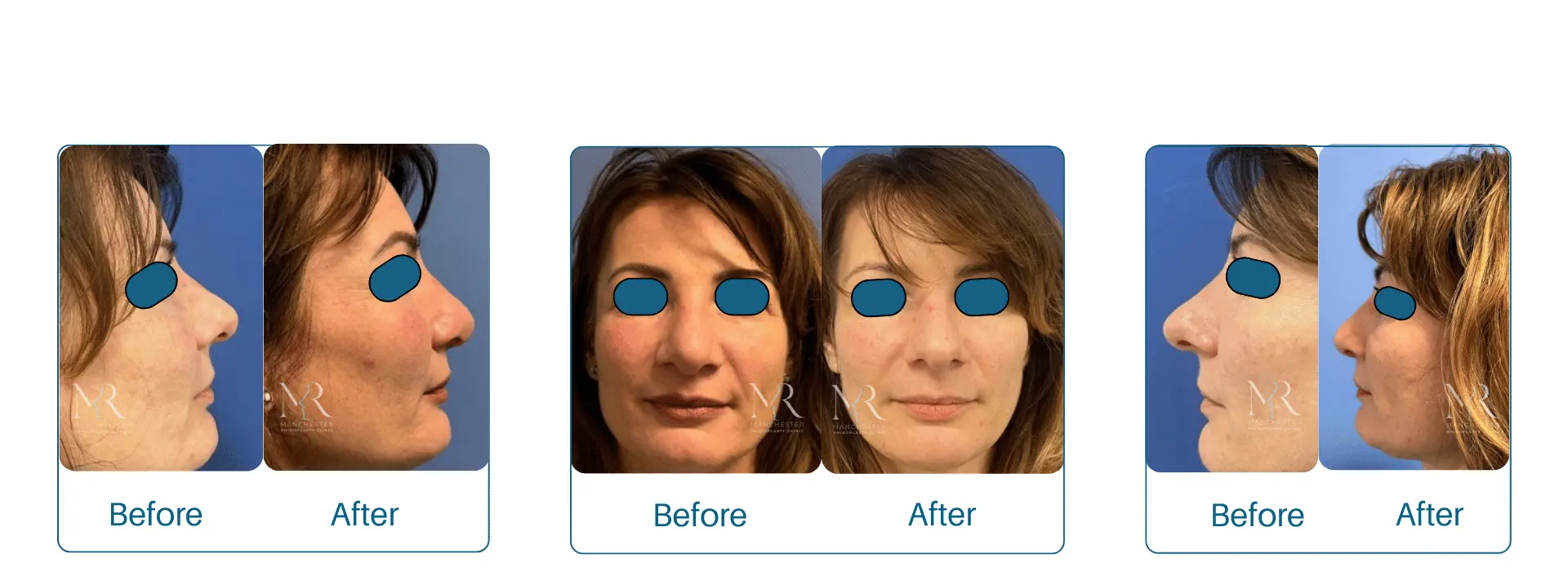 Rhinoplasty Pictures