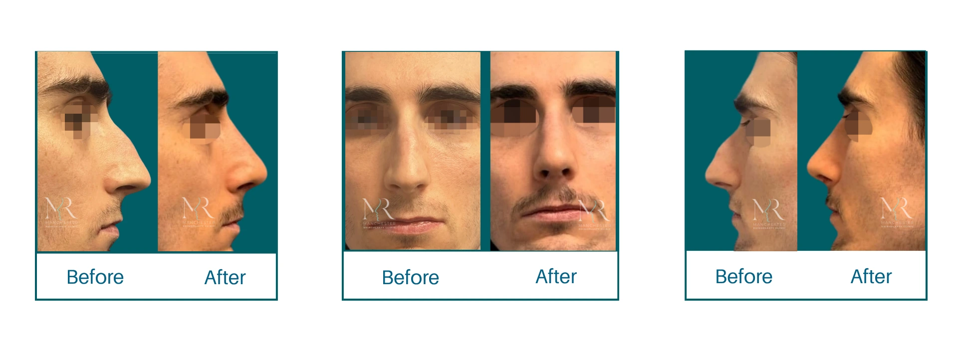 Male Rhinoplasty Picture