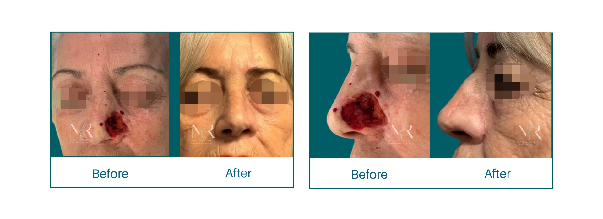 Nasal reconstruction