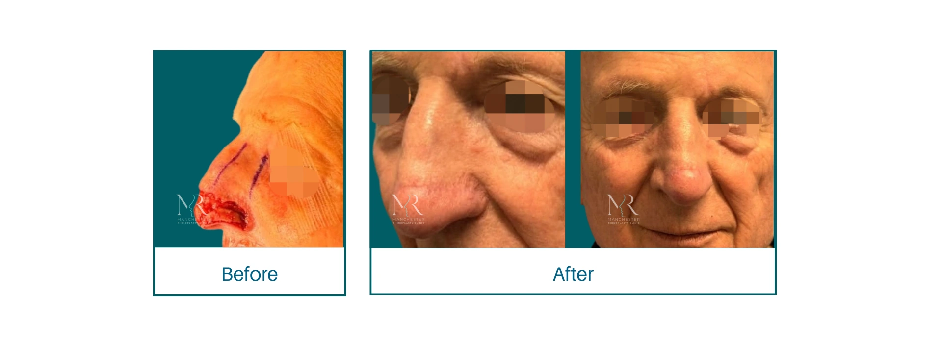 Nasal reconstruction