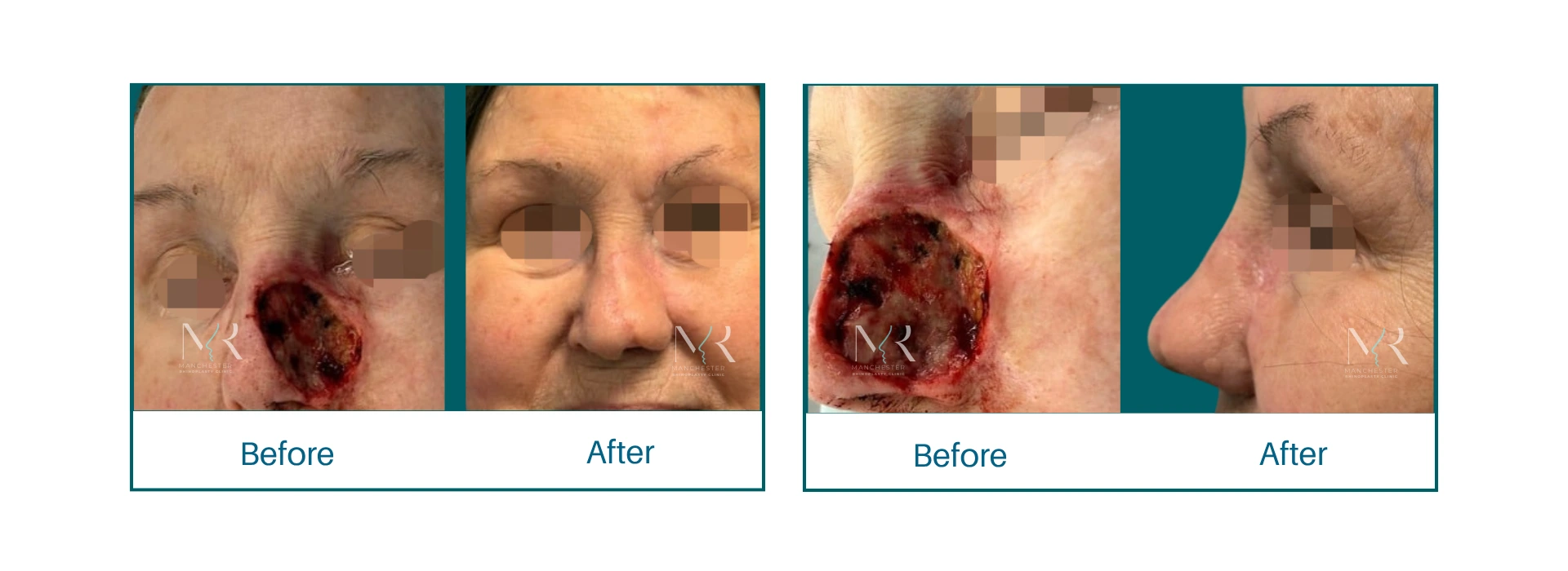 Nasal reconstruction