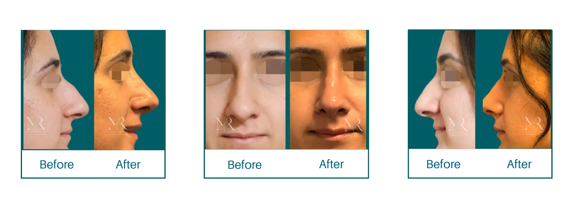 Rhinoplasty Picture