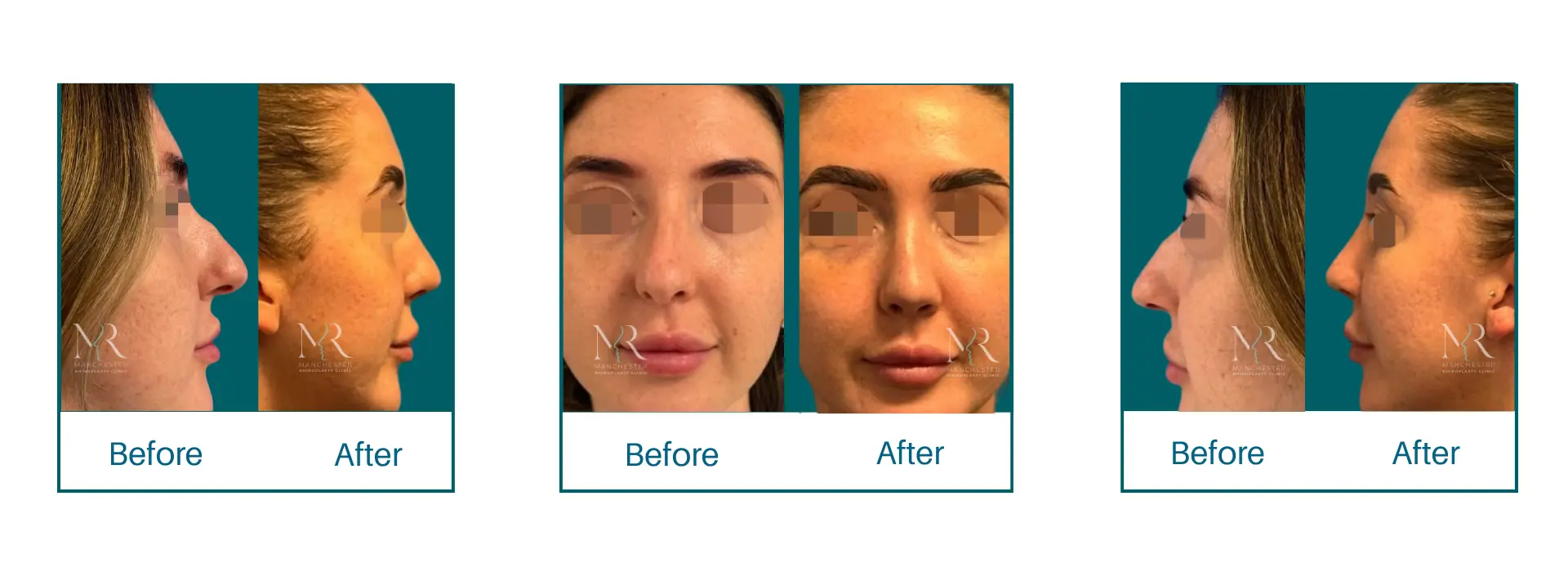 Rhinoplasty Picture