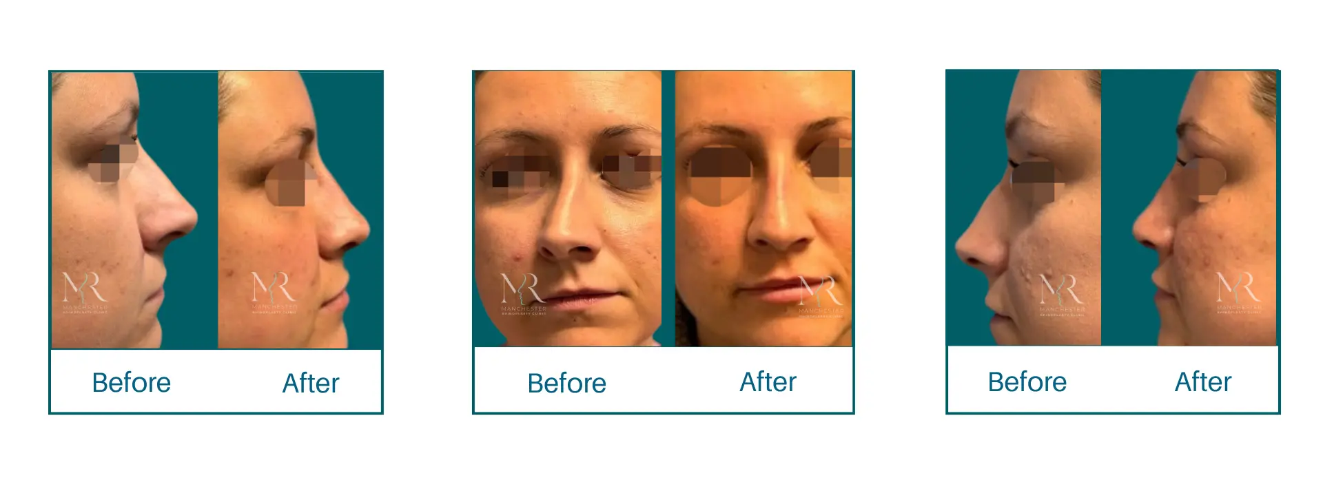 Rhinoplasty Picture