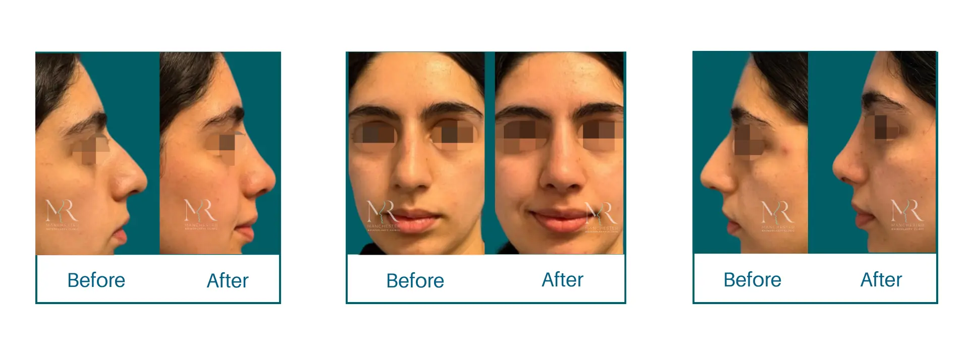 Rhinoplasty Picture