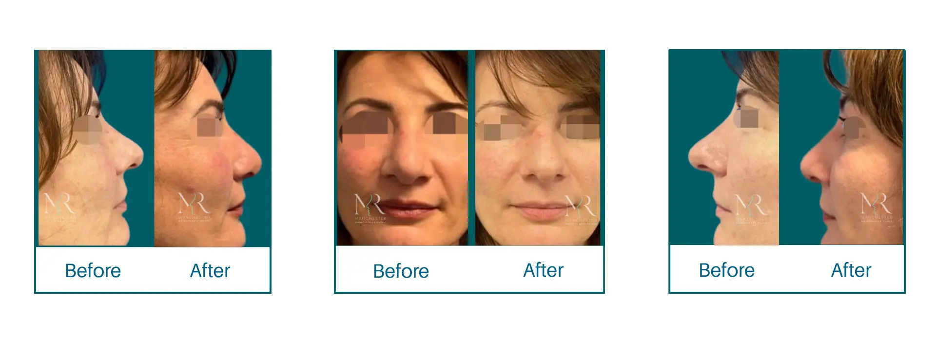 Rhinoplasty Picture